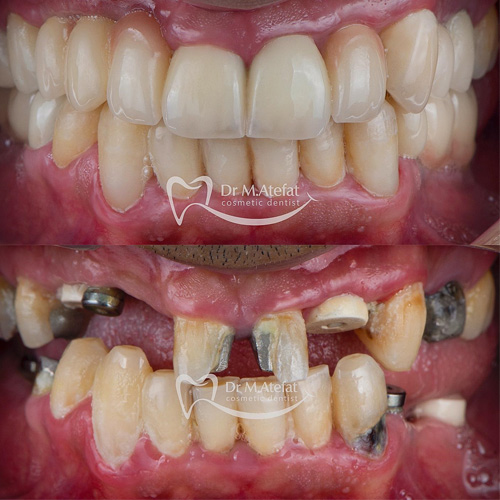 قرار دادن ایمپلنت دندان