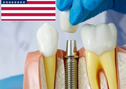 ایمپلنت دندان آمریکایی
