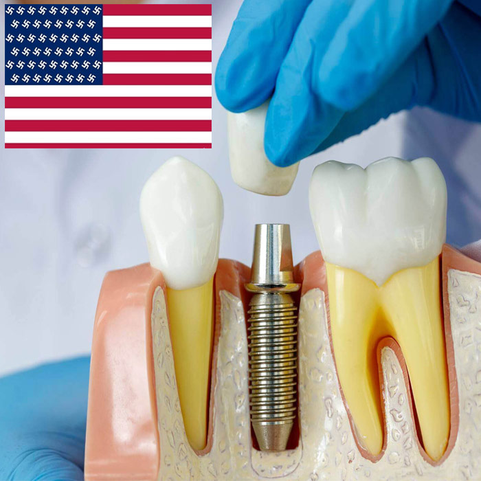 ایمپلنت دندان آمریکایی