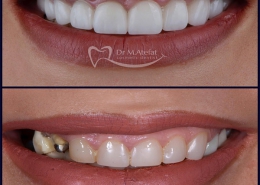 5 دلیل برای تسریع در انجام ایمپلنت دندان