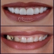 5 دلیل برای تسریع در انجام ایمپلنت دندان