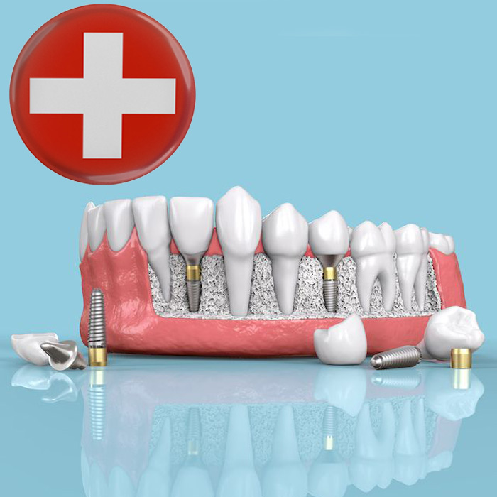 ایمپلنت دندان سوئیسی