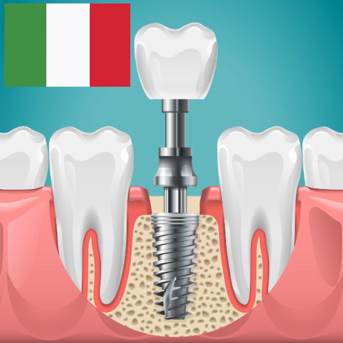 ایمپلنت دندان ایتالیایی
