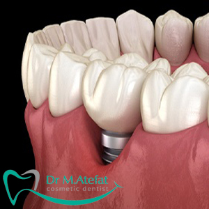 عوارض جانبی ایمپلنت دندان