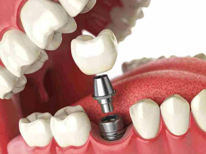 فاصله بین کشیدن دندان و کاشت ایمپلنت