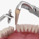 فاصله بین کشیدن دندان و کاشت ایمپلنت