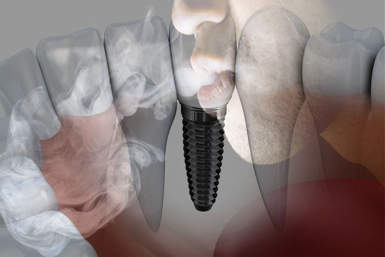 تاثیر سیگار بر روی ایمپلنت دندان چیست