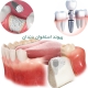 پیوند استخوان دندان چیست