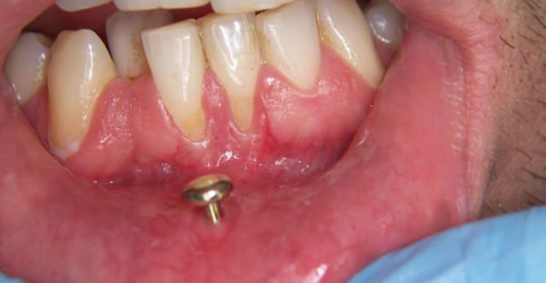 مضرات پیرسینگ ناحیه دهان - سایش لثه