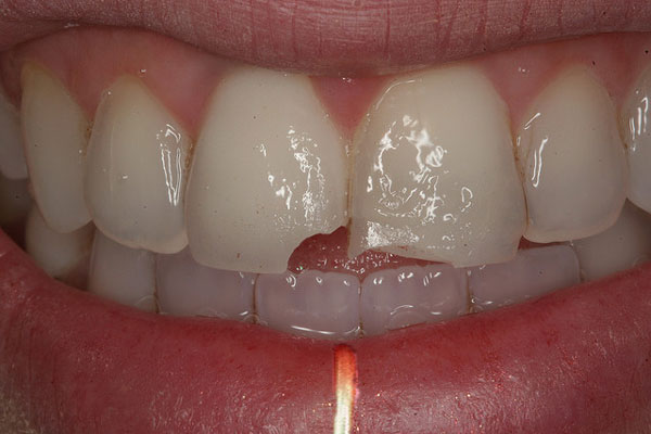 مضرات پیرسینگ ناحیه دهان - شکستن دندان