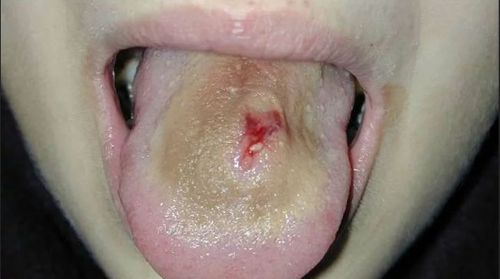 مضرات پیرسینگ ناحیه دهان - عفونت زبان