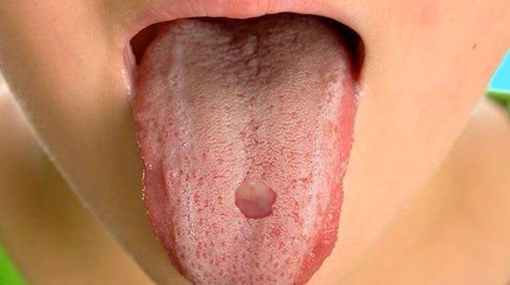 مضرات پیرسینگ ناحیه دهان - تشکیل کلوئید