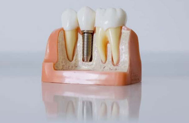 ایمپلنت های دندانی اشترومن