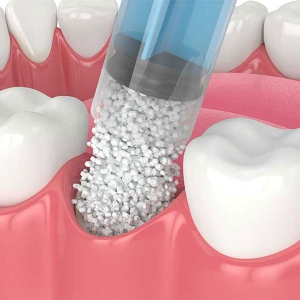 پودر استخوان چیست چه تاثیری در ایمپلنت دندان دارد