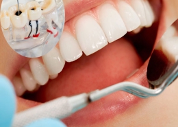 آیا دندان عصب کشی شده را می توان لمینت کرد