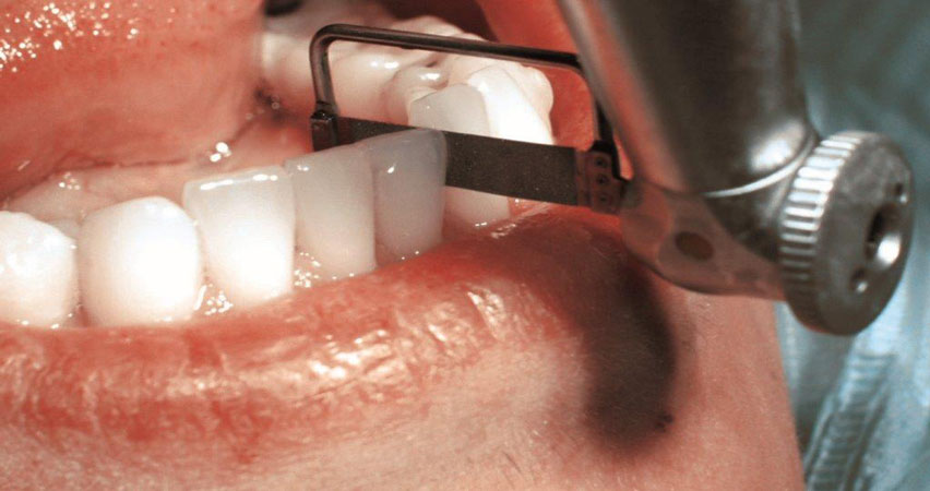 امبراژور دندان - ارتودنسی با استریپینگ