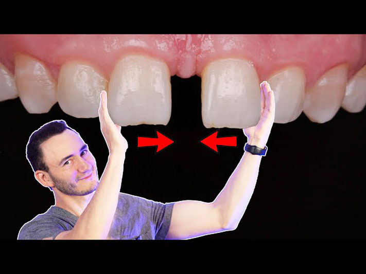 دیاستما یا فاصله بین دندان ها چیست - بستن فاصله بین دندانی