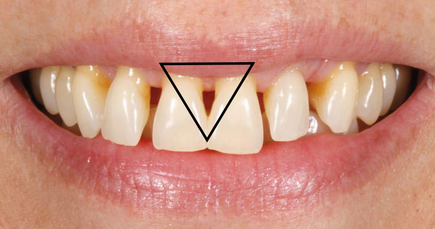 امبراژور دندان چیست