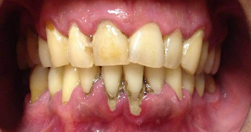 امبراژور دندان در اثر پریودنتیت