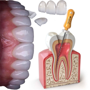 امکان عصب کشی دندان لمینت شده وجود دارد یا خیر