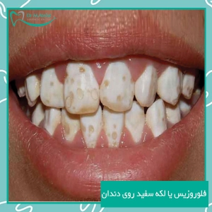فلوروزیس یا لکه سفید روی دندان چیست