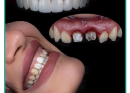 آیا لمینت سبب پوسیدگی دندان می شود