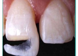دلایل افتادن لمینت دندان چیست