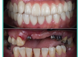 عوامل موثر بر موفقیت ایمپلنت دندان