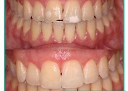 هیپوپلازی مینای دندان چیست