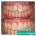 هیپوپلازی مینای دندان چیست