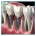 ایمپلنت دندان در کاشان