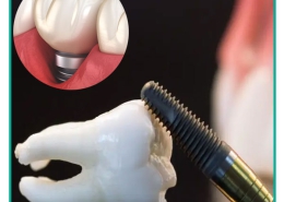 تحلیل لثه بعد از کاشت ایمپلنت دندان