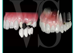 مقایسه و تفاوت ایمپلنت و بریج دندان