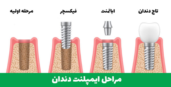 مراحل ایمپلنت دندان 