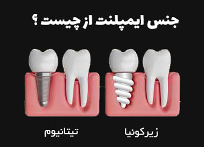 جنس ایمپلنت دندان